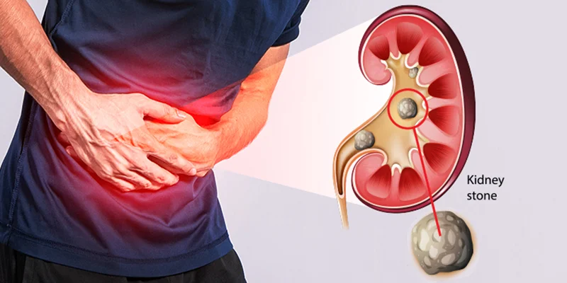 Ayurvedic treatment for kidney stones