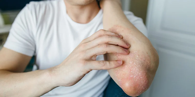 Ayurvedic treatment for psoriasis